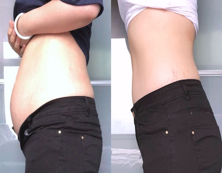 stomach binding before and after