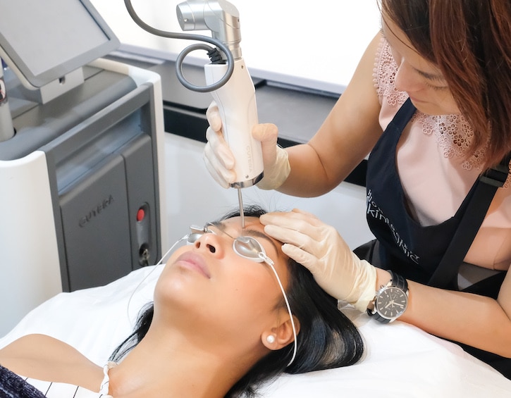 beauty laser removal unwanted pigmentation