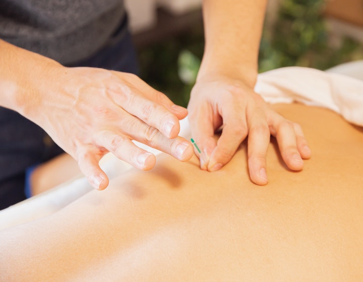 Alternative therapy in Hong Kong, acupuncture 